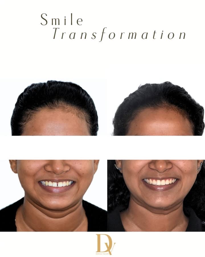 Before and after a smile transformation