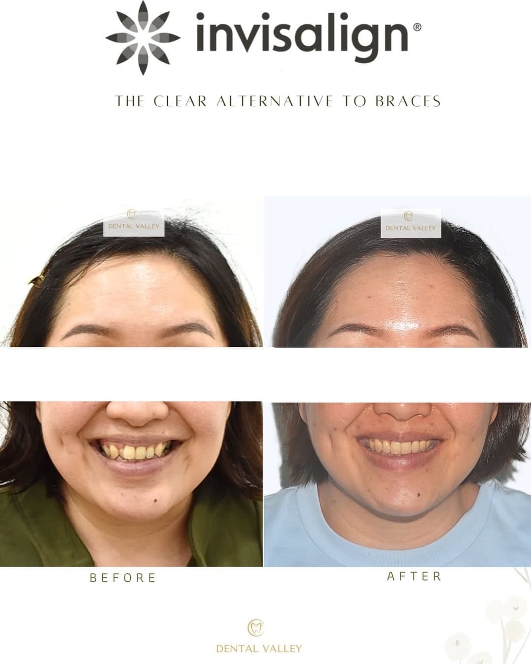 Before and after Invisalign clear aligner treatment