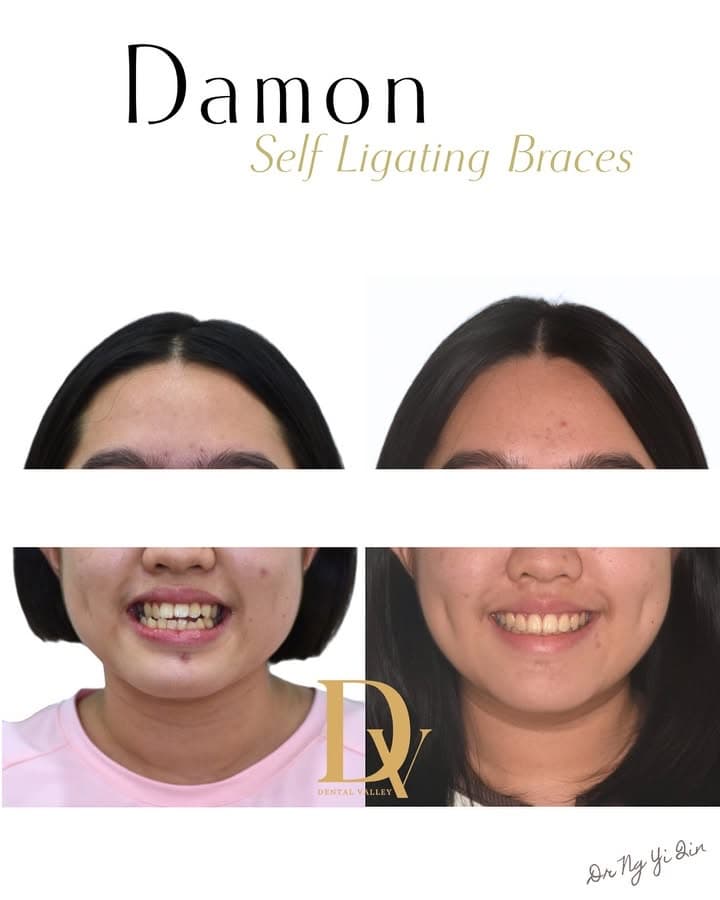 Before and after Damon self-ligating braces