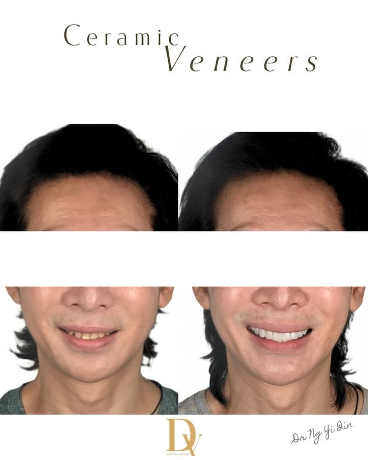 Before and after ceramic veneers