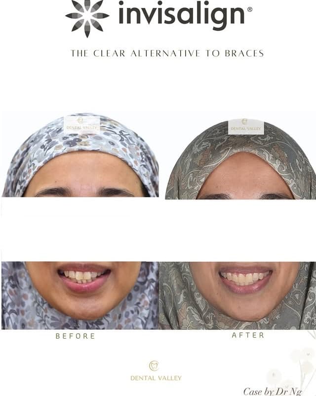 Before and after Invisalign clear aligner treatment