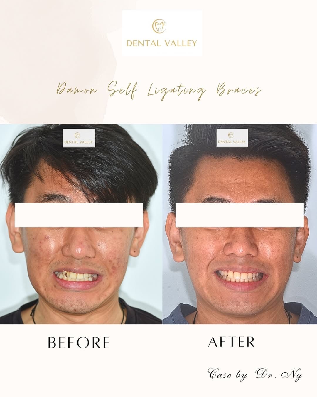 Before and after Damon self-ligating braces, case by Dr. Ng