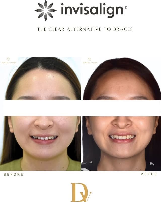 Before and after Invisalign clear aligner treatment
