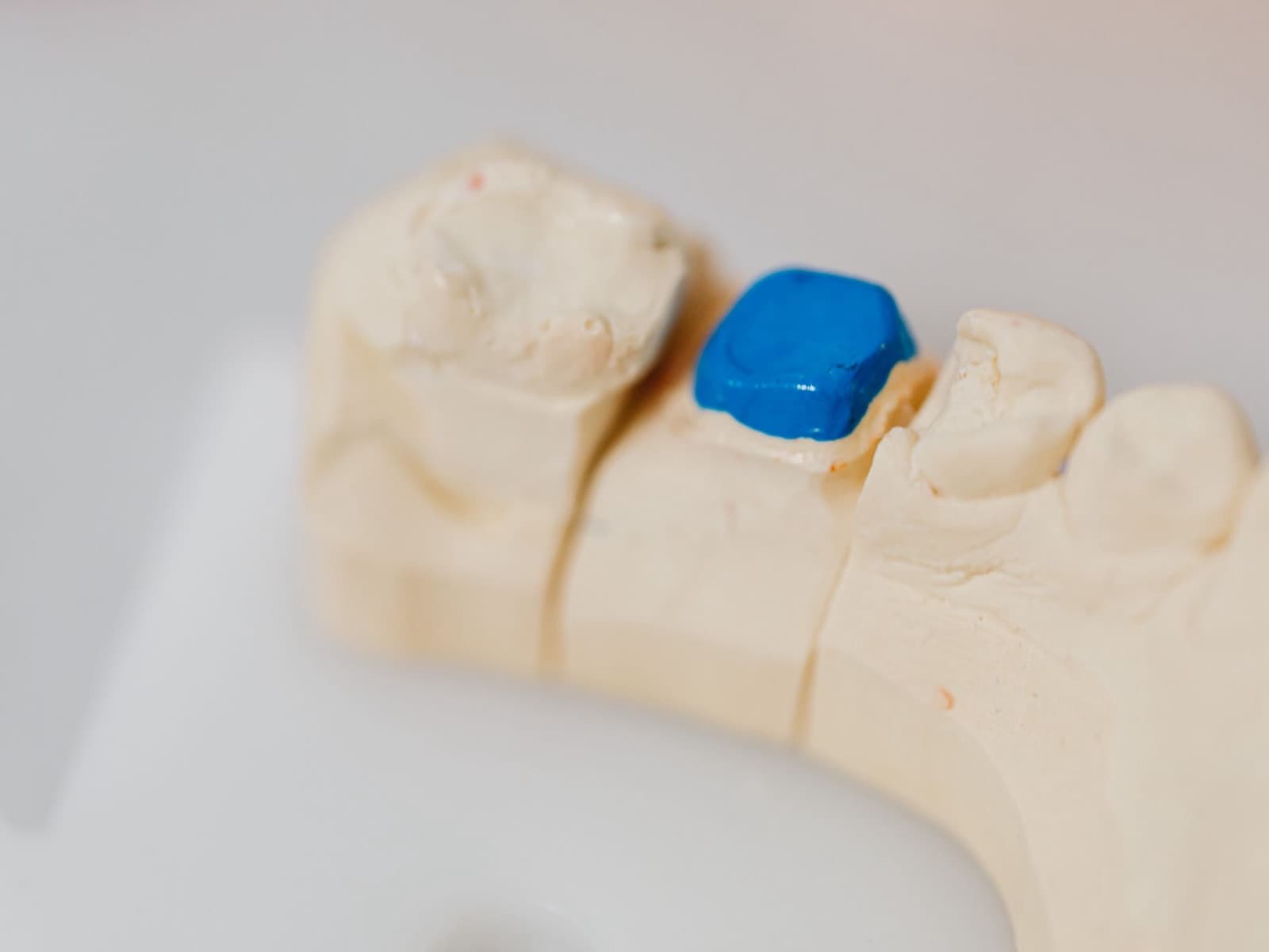 Biomimetic Restorations