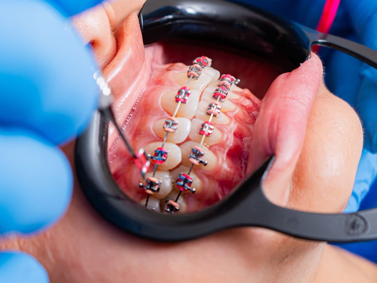 Braces