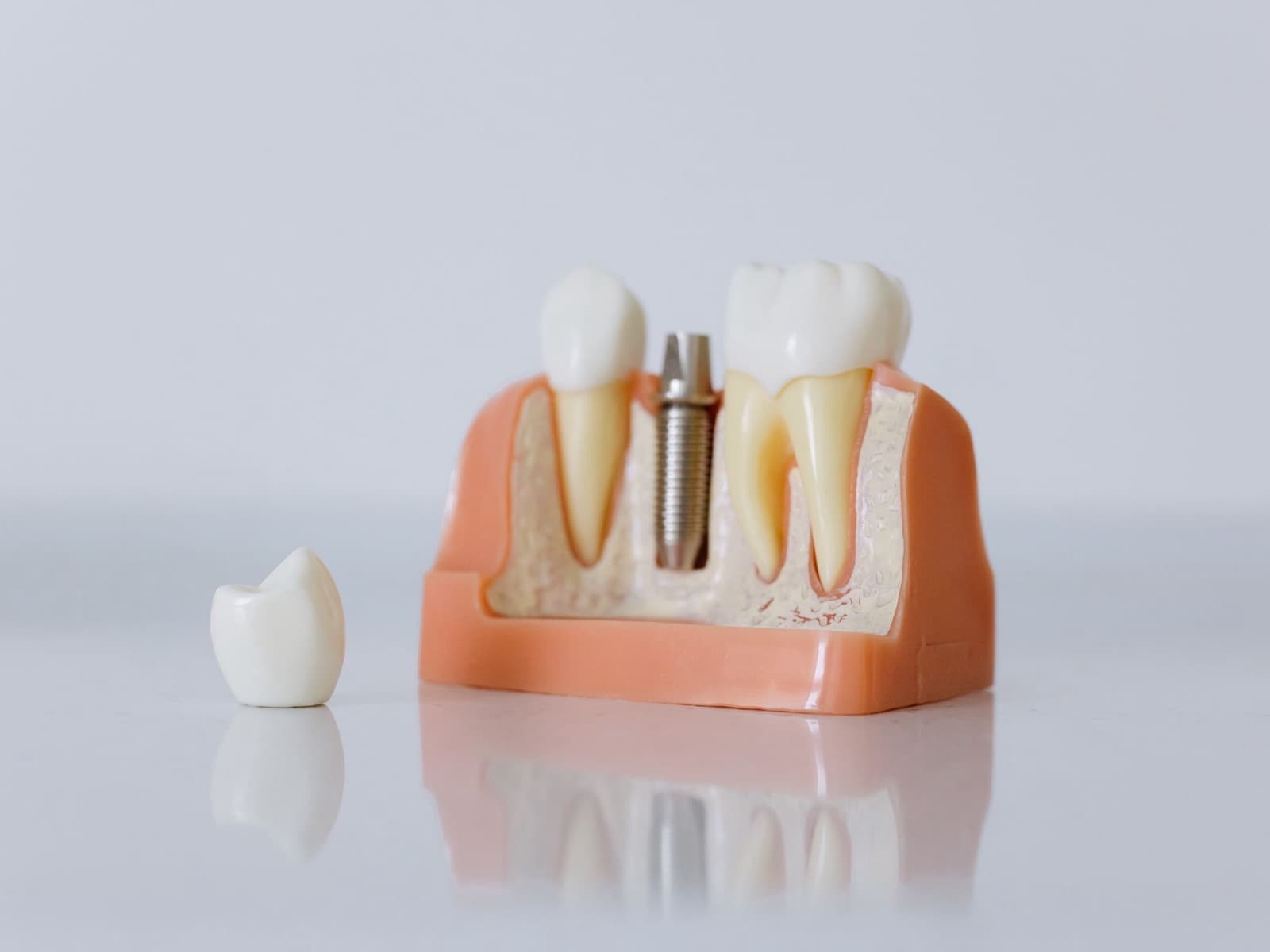Dental Implants